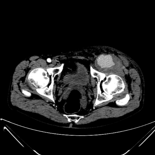 Спонтанный разрыв аневризмы левой общей бедренной артерии у пациента с сифилисом