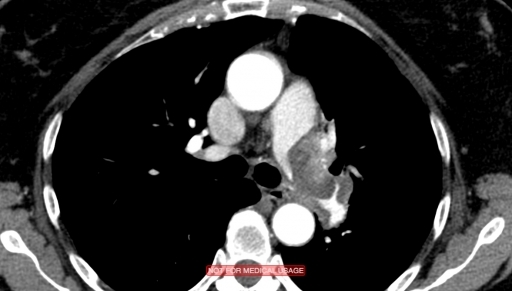 Ангиосаркома лёгочной артерии