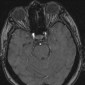 Аневризма сосудов головного мозга Аневризма супраклиновидного отдела левой ВСА, подострое кровоизлияние в левые отделы хиазмы и левый зрительный тракт. Лакунарный инсульт левой ножки мозга.