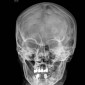Метастатическое поражение костей свода черепа Метастаз аденокарциномы молочной железы (button sequestrum sign)