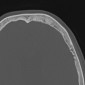 Дифференциальная диагностика поражений костей свода черепа Метастаз аденокарциномы молочной железы (button sequestrum sign)