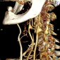 Патологическая деформация и аномалии магистральных артерий Кинкинг и аневризмы экстракраниальных сегментов внутренних сонных артерий (kinking and extracranial carotid aneurisms)