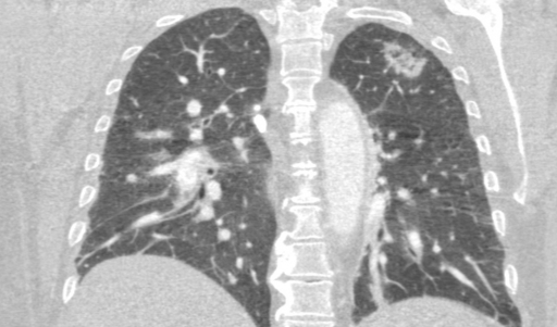 Туберкулез легких, субсолидный узел, признак обратного гало (subsolid lung node, tuberculosis, reverce halo)