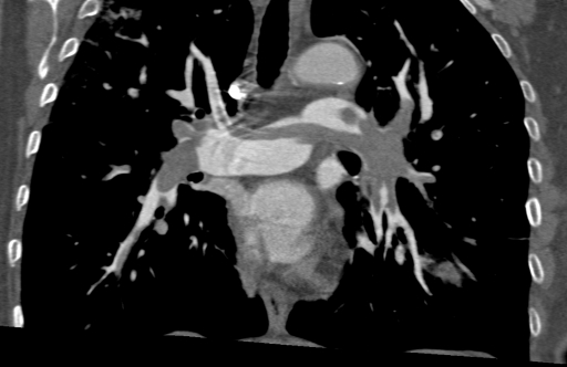 Массивная тромбоэмболия легочных артерий с двумя тромбами наездниками и легочной гипертензией