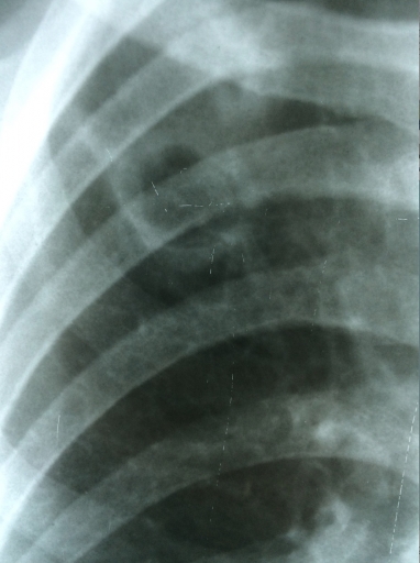 Инфильтративный туберкулез с распадом (Infiltrative tuberculosis)