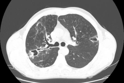 Исход кавернозного туберкулеза легких (Cavernous pulmonary tuberculosis  outcome)