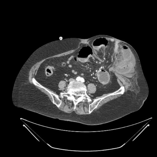 Тонкокишечная непроходимость - парастомийная грыжа (Small bowel obstruction - parastomic hernia)