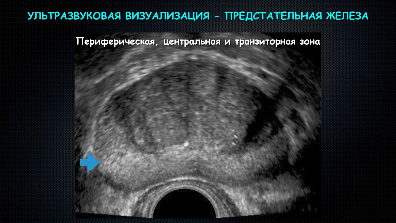 Предстательная железа переходная зона. Гиперплазия предстательной железы УЗИ. ЦДК предстательной железы. Переходные зоны предстательной железы на УЗИ. Трузи предстательной железы гиперплазия.