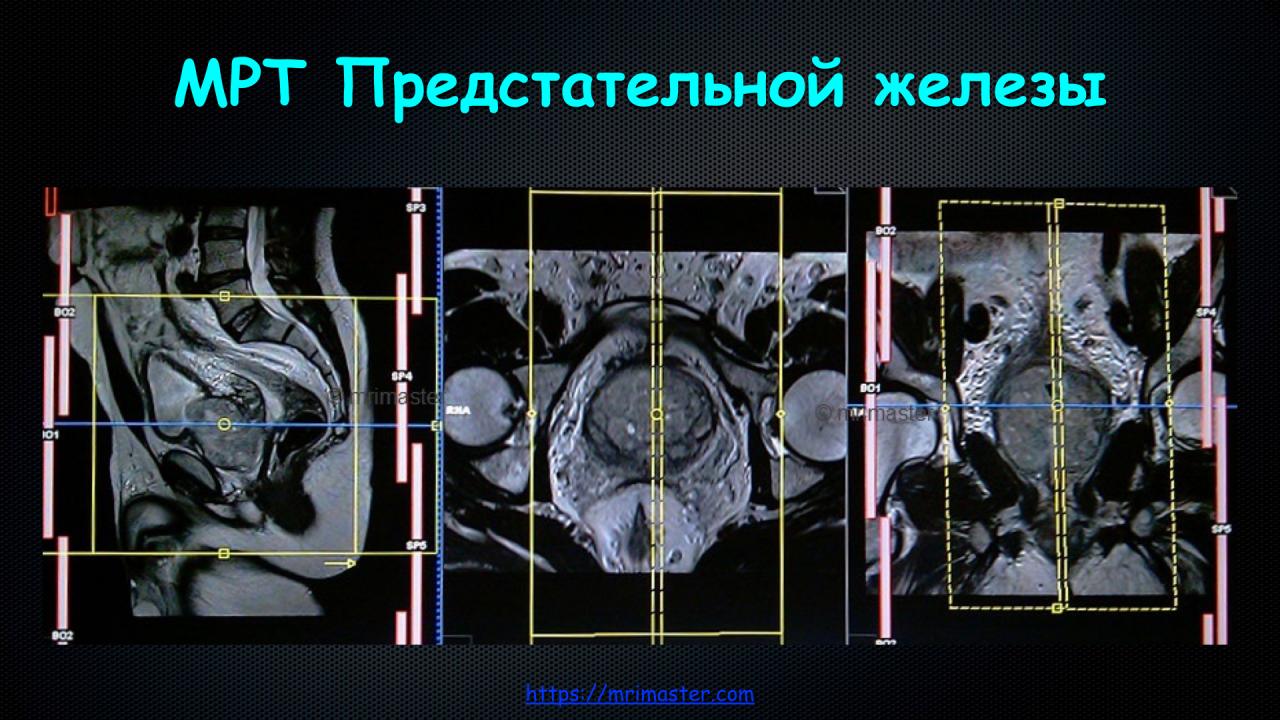 Аденома простаты мрт. Мультипараметрическое мрт предстательной железы. Магнитно-резонансная томографии (мрт) предстательной железы. Предстательная железа мрт сагитал.