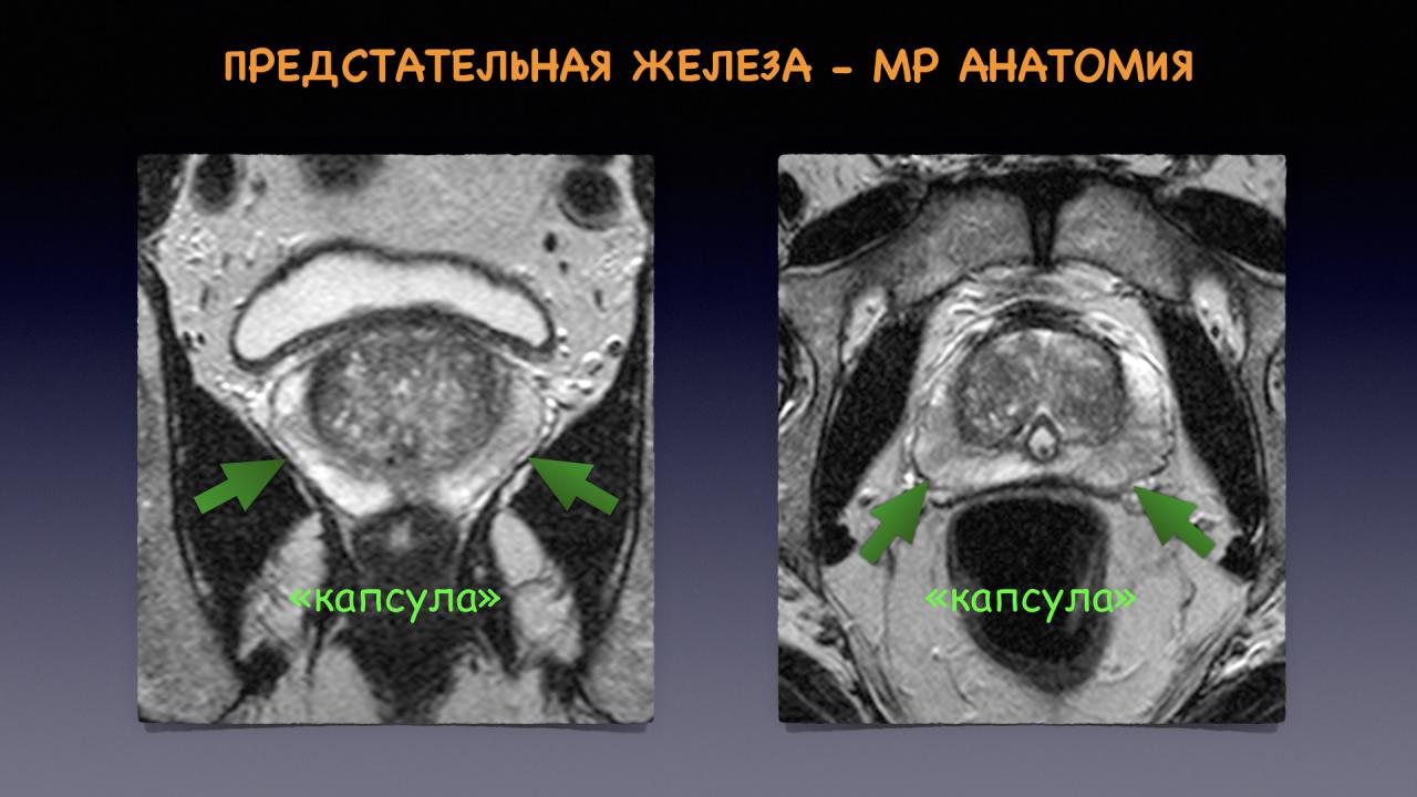Аденома простаты мрт. Аденоматозные узлы предстательной железы мрт. Мультипараметрическое мрт предстательной железы. Pirads мрт предстательной железы. Зональная анатомия предстательной железы мрт.