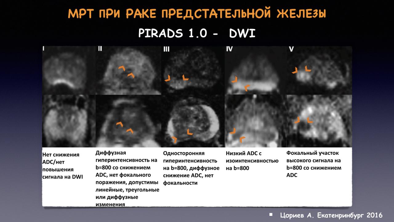 Транзиторная зона предстательной железы. Схема предстательной железы Pirads. Pirads 3 предстательной железы. Аденокарцинома предстательной железы мрт. Мультипараметрическое мрт предстательной железы.