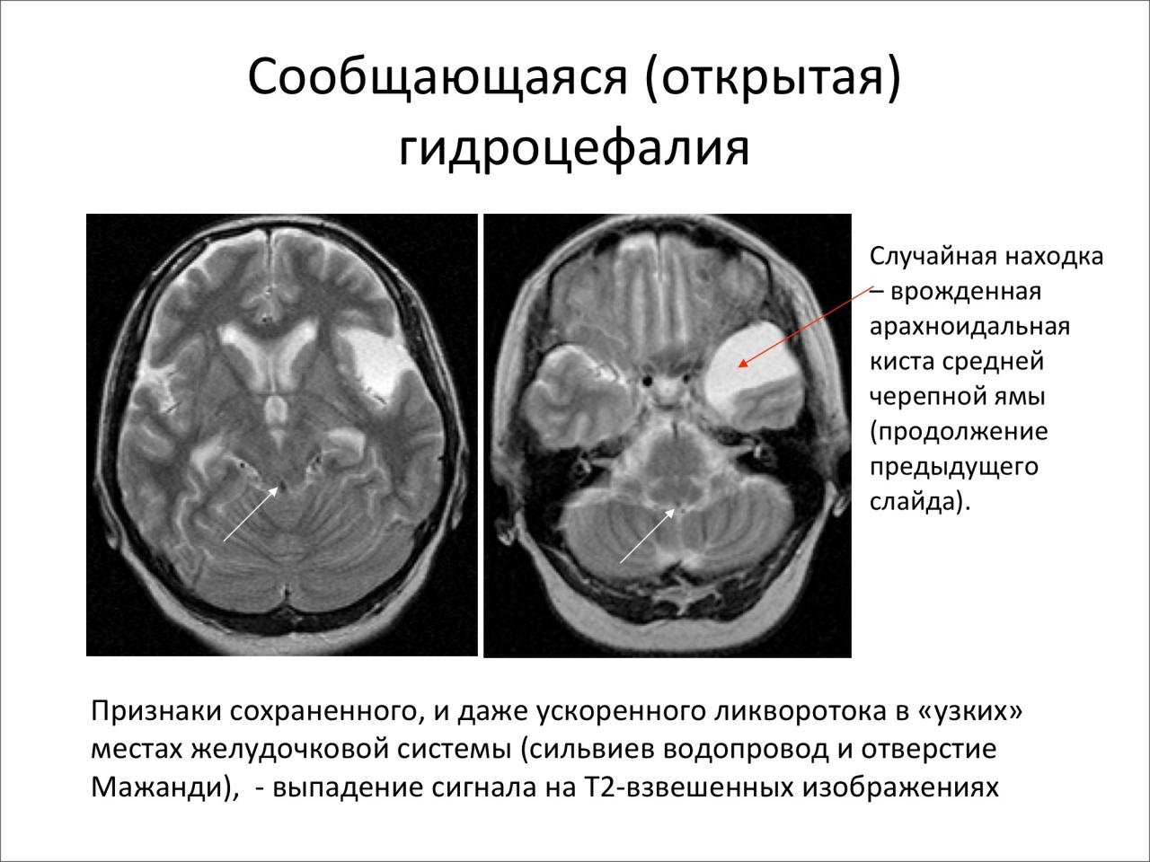 Открытая гидроцефалия головного мозга кт. Клинические симптомы гидроцефалии. Окклюзионная гидроцефалия кт. Гидроцефалия на кт классификация.