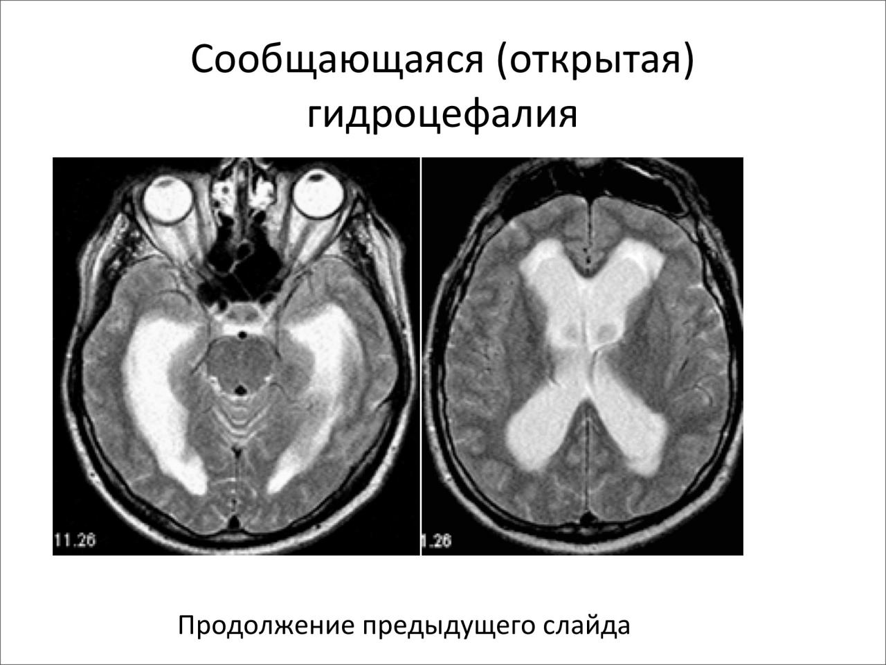 Выражено умеренно гидроцефалия мозга. Окклюзионная гидроцефалия мрт. Заместительная наружная гидроцефалия кт. Внутренняя открытая гидроцефалия мрт. Арезорбтивная гидроцефалия головного мозга.