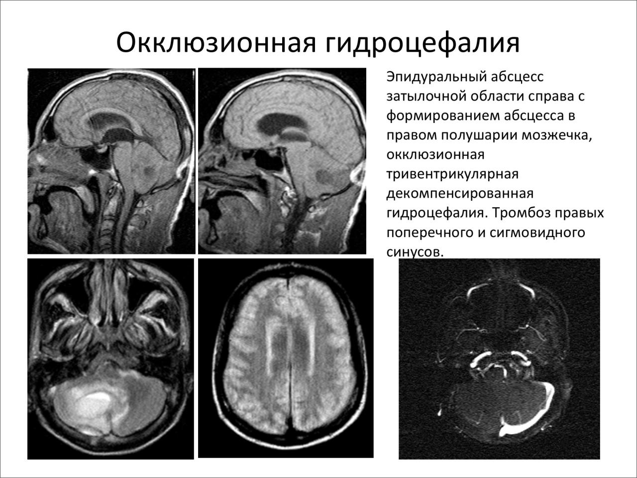 Лечение наружная гидроцефалия мозга