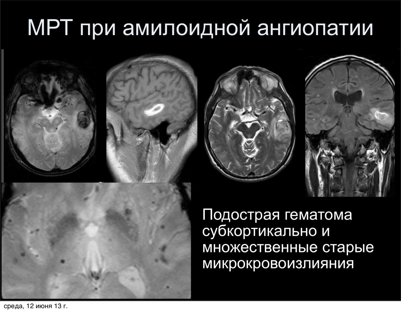 Микроангиопатия на мрт. Амилоидная ангиопатия сосудов головного мозга. Церебральная амилоидная ангиопатия мрт головного мозга. Церебральная микроангиопатия кт. Амилоидная ангиопатия кт.
