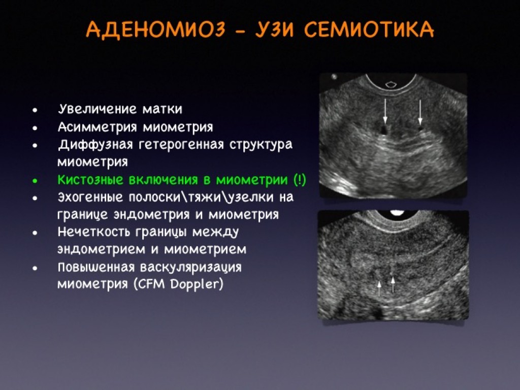 Структурные изменения матки. Аденомиоз . Патология эндометрия. Патология эндометрия УЗИ.