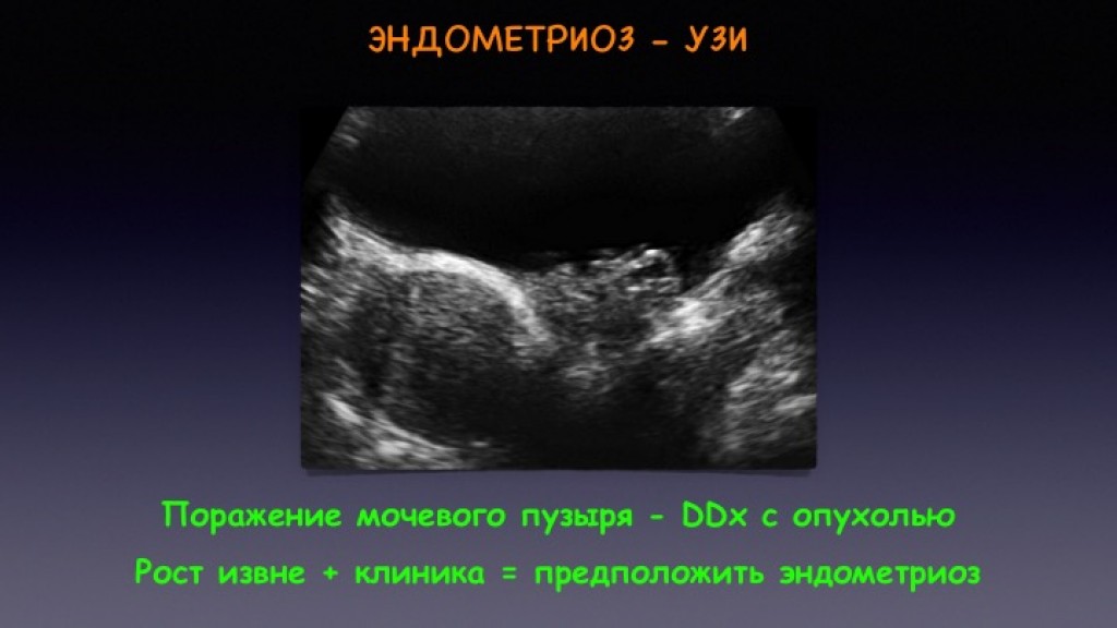 Узи признаки эндометриоза матки. Эндометриоз мочевого пузыря на УЗИ. Узловая форма аденомиоза УЗИ.
