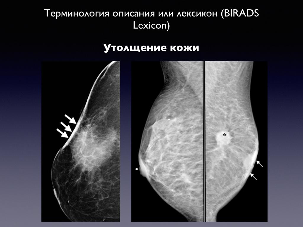 Маммография и рентген в один день можно